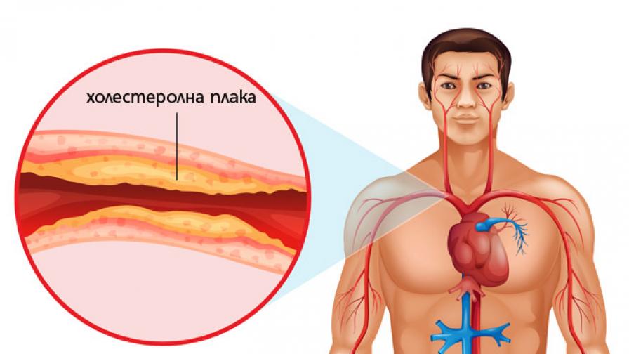 Холестеролните плаки стесняват кръвоносните съдове и водят до опасни нарушения в кръвотока