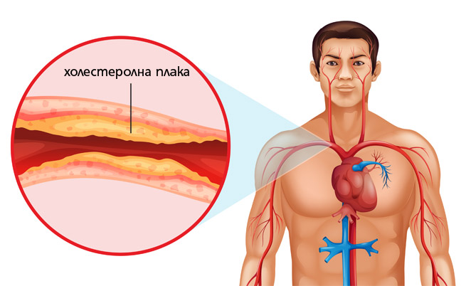 Опасен ли е холестеролът?