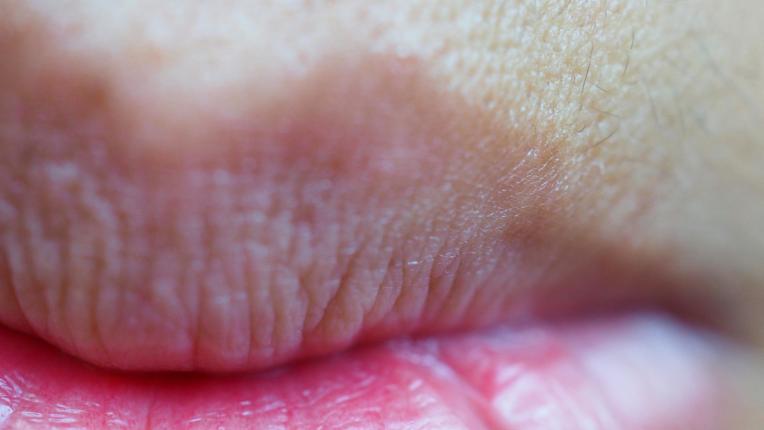 Напукани, парещи, сухи: какво издават устните за здравето ни