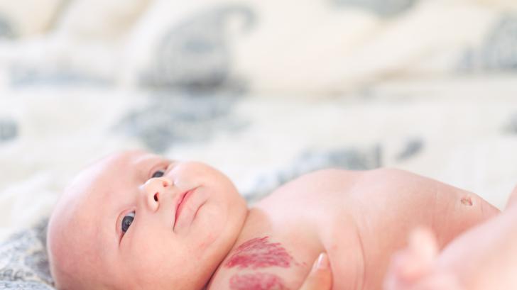 Родилни петна при новороденото ми бебе - да се страхувам ли? (СНИМКИ)