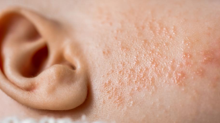 Бебешко акне - как изглежда и как се лекува (СНИМКИ)