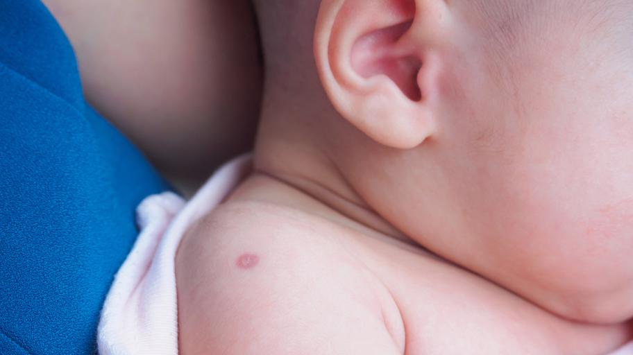 За бебе на 7 месеца: Проверка на белег след БЦЖ ваксина (СНИМКА)