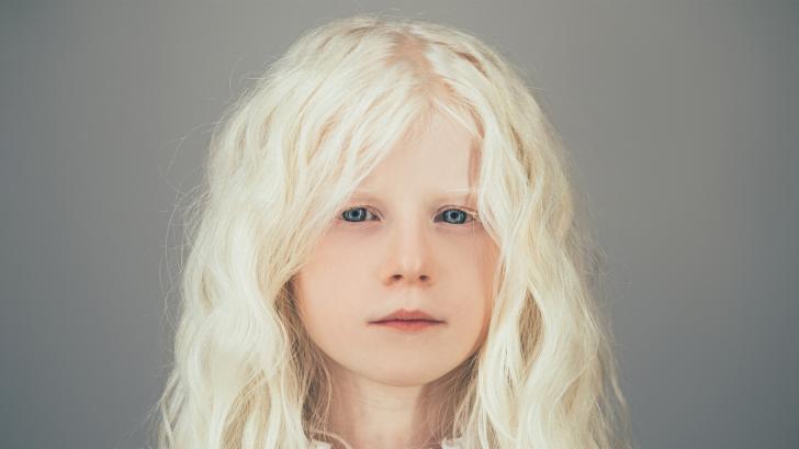 Те приличат на ангели. Но какво се крие зад болестта на хората с албинизъм? (СНИМКИ)