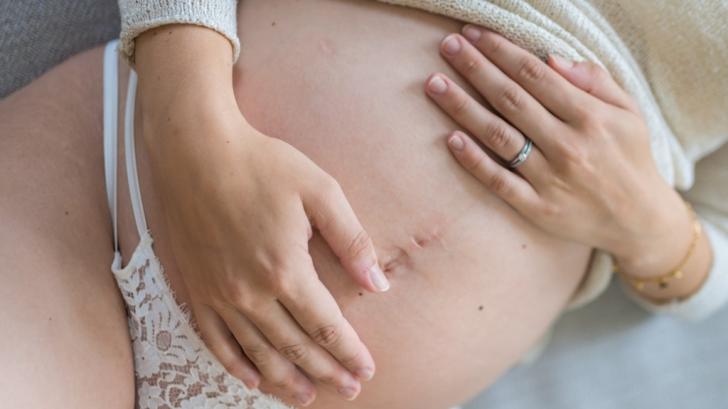 Какво е ПУПП? Как да облекчим обрив на корем по време на бременност?