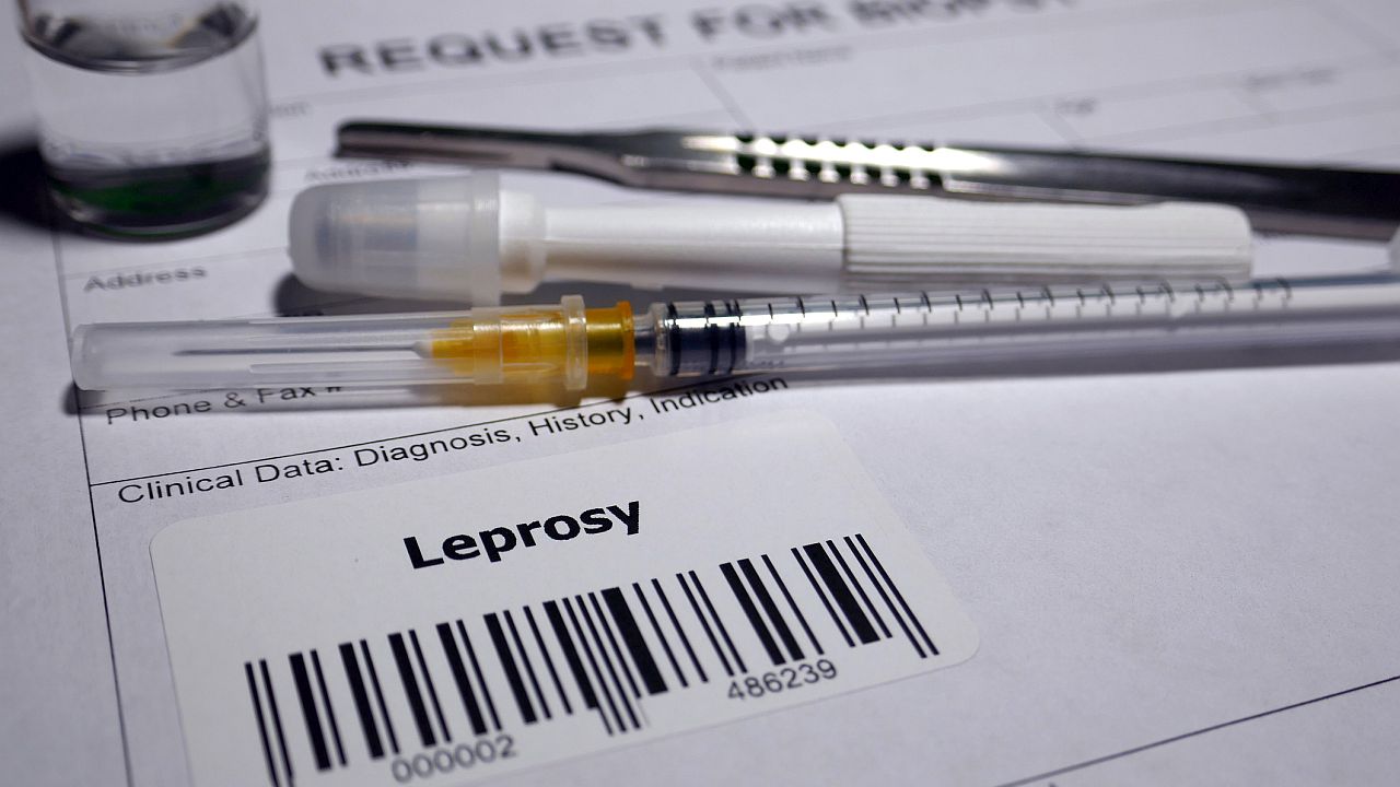 Случаи на проказа са регистрирани в Хърватия и Румъния