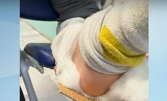 Обездвижили счупен крак на дете с картон в Разлог