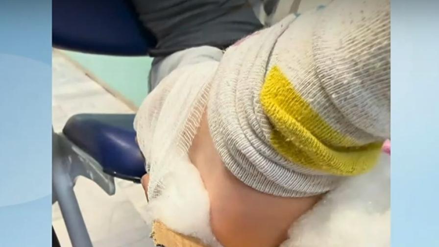 Обездвижили счупен крак на дете с картон в Разлог