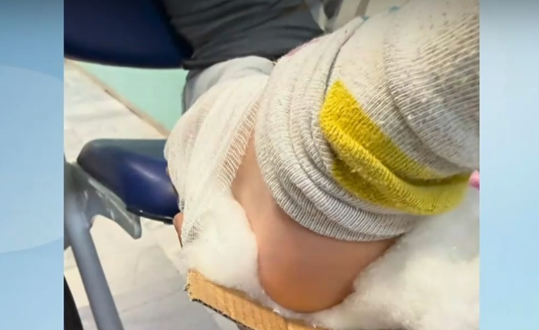 Обездвижили счупен крак на дете с картон в Разлог