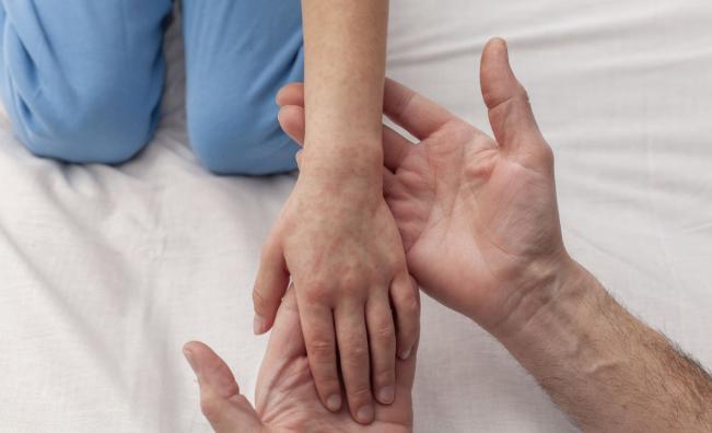 <p>Ръст на случаите на морбили у нас</p>