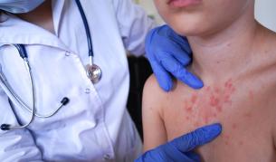 Нови случаи на заразени с морбили във Враца и Плевен