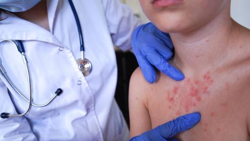 Расте броят на болните от морбили в страната, случаите са вече над 100