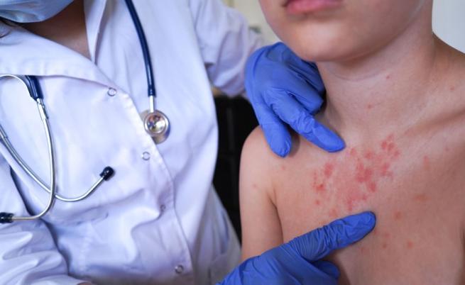 Расте броят на болните от морбили в страната, случаите са вече над 100