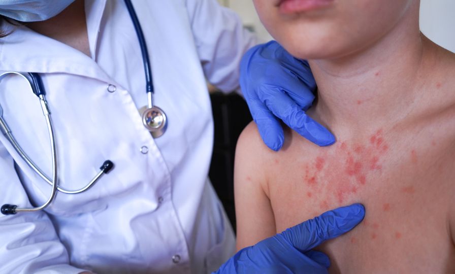 Расте броят на болните от морбили в страната, случаите са вече над 100