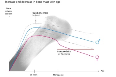 Остеопорозата - една от болестите на века